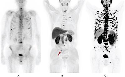 Frontiers PSMA PET In Imaging Prostate Cancer